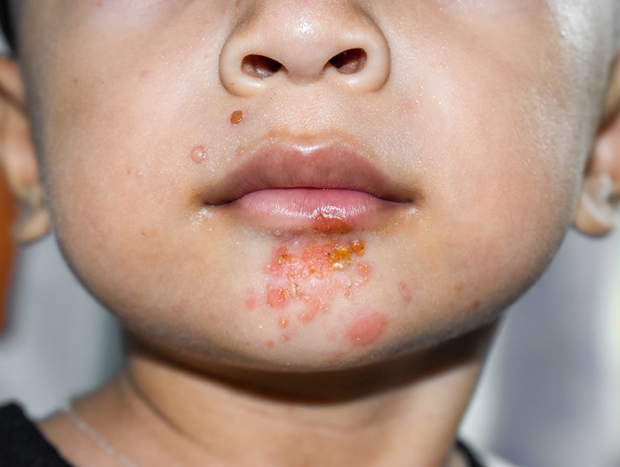 patiënt met huiduitslag (impetigo)